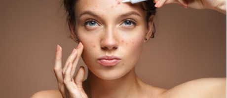 How should I take care of my acne prone skin ?